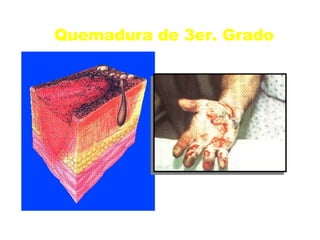 Quemadura de 3er. Grado