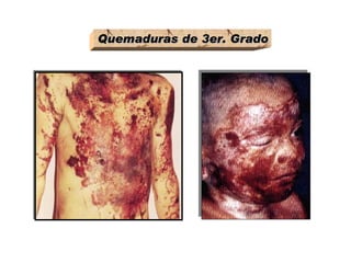 Quemaduras de 3er. Grado