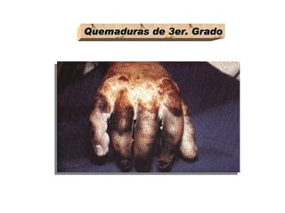 Quemaduras de 3er. Grado