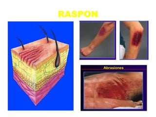 RASPON