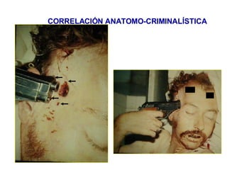 CORRELACIÓN ANATOMO-CRIMINALÍSTICA