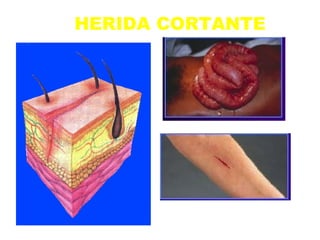 HERIDA CORTANTE