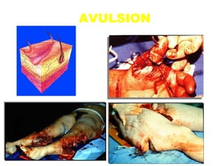 AVULSION