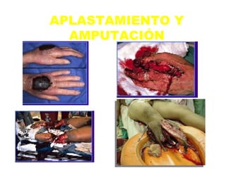 APLASTAMIENTO Y AMPUTACIÓN