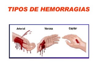 TIPOS DE HEMORRAGIAS