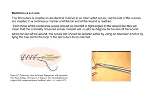 Continuous sutures
The first suture is inserted in an identical manner to an interrupted suture, but the rest of the sutures
are inserted in a continuous manner until the far end of the wound is reached.
Each throw of the continuous suture should be inserted at right angles to the wound and this will
mean that the externally observed suture material will usually lie diagonal to the axis of the wound.
At the far end of the wound, this suture line should be secured either by using an Aberdeen knot or by
tying the free end to the loop of the last suture to be inserted.
 
