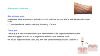 Alternatives to sutures
Skin adhesive strips
used where there is no tension and not too much moisture, such as after a wide excision of a breast
lump.
• They may also be used to minimize ‘spreading’ of a scar.
Tissue glue
Tissue glue is also available based upon a solution of n-butyl-2-cyanoacrylate monomer.
When it is applied to a wound, it polymerises to form a firm adhesive bond
the wound does need to be clean, dry, with near perfect haemostasis and under no tension.
 