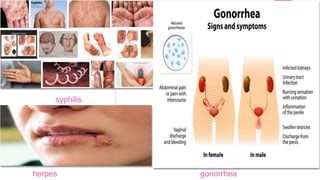 syphilis
gonorrheaherpes
 