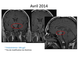 Avril 2014
* Prolactinémie= 184 µg/l
* Pas de modification du Dostinex
 