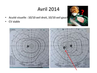 Avril 2014
• Acuité visuelle : 10/10 oeil droit, 10/10 oeil gauche
• CV stable
?
 