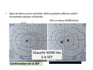 • Signe de Marcus Gunn œil droit: déficit pupillaire afférent relatif=
neuropathie optique unilatérale
Bilan en neurologie:
Confirmation de la SEP
PEV: en faveur NORB droite
Paraparésie depuis 2010Séquelle NORB liée
à la SEP
 