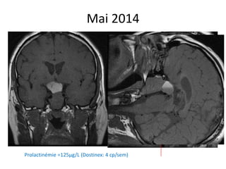 Mai 2014
Prolactinémie =125µg/L (Dostinex: 4 cp/sem)
 