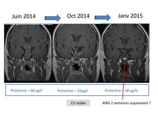 Juin 2014
Prolactine = 86 µg/l Prolactine = 29µg/l
Oct 2014
CV stable AINS 2 semaines auparavant ?
Janv 2015
Prolactine = 18 µg/lL
 