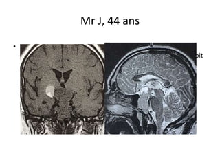 Mr J, 44 ans
• Octobre 2009: BAV œil droit (7/10) et hémianopsie latérale
homonyme gauche avec atteinte prédominante de l’oeil droit
(Limoges)
 