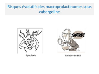 Risques évolutifs des macroprolactinomes sous
cabergoline
Apoplexie Rhinorrhée LCR
 