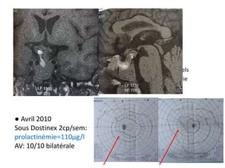 • prolactinémie à 865 µg/l
• Début du DOSTINEX® (1 puis 2cp /semaine)
• Décembre 2009:
– Apoplexie hypophysaire avec aggravation des troubles visuels
– le 24 décembre 2009 exérèse partielle de l’adénome par voie
endonasale (Limoges). Anapath: prolactinome
● Avril 2010
Sous Dostinex 2cp/sem:
prolactinémie=110µg/l
AV: 10/10 bilatérale
 