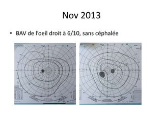 Nov 2013
• BAV de l’oeil droit à 6/10, sans céphalée
 