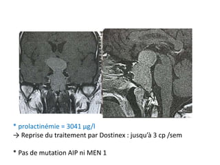 * prolactinémie = 3041 µg/l
→ Reprise du traitement par Dostinex : jusqu’à 3 cp /sem
* Pas de mutation AIP ni MEN 1
 