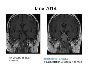 Janv 2014
Prolactinémie= 230 µg/L
→ augmentation Dostinex à 4 cp / sem
AV: OD 9/10, OG 10/10
CV stable
 