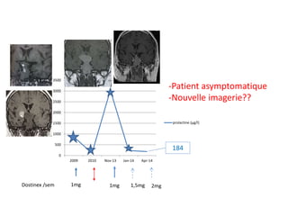 Dostinex /sem 1mg 1mg 1,5mg 2mg
-Patient asymptomatique
-Nouvelle imagerie??
0
500
1000
1500
2000
2500
3000
3500
2009 2010 Nov-13 Jan-14 Apr-14
prolactine (µg/l)
184
 