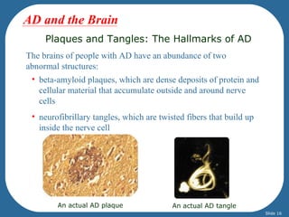 AD and the Brain
     Plaques and Tangles: The Hallmarks of AD
The brains of people with AD have an abundance of two
abnormal structures:
 • beta-amyloid plaques, which are dense deposits of protein and
   cellular material that accumulate outside and around nerve
   cells
 • neurofibrillary tangles, which are twisted fibers that build up
   inside the nerve cell




        An actual AD plaque               An actual AD tangle
                                                                     Slide 16
 