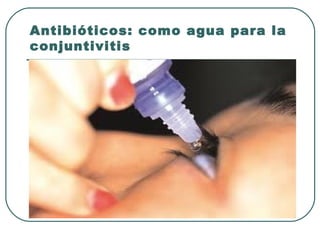 Antibióticos: como agua para la
conjuntivitis
 