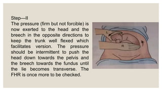 Step—II
The pressure (firm but not forcible) is
now exerted to the head and the
breech in the opposite directions to
keep the trunk well flexed which
facilitates version. The pressure
should be intermittent to push the
head down towards the pelvis and
the breech towards the fundus until
the lie becomes transverse. The
FHR is once more to be checked.
 