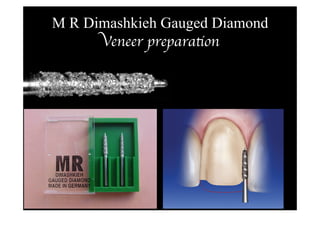 M R Dimashkieh Gauged Diamond
Veneer preparation 
 