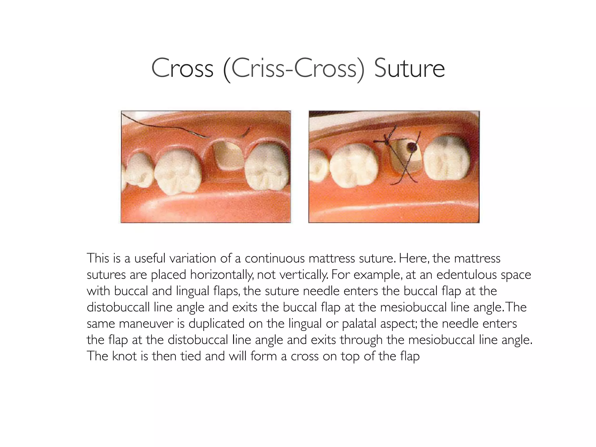 Periodontal instruments, surgery | PDF