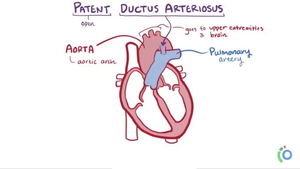 ACYANOTIC CONGENITAL HEART DISEASES