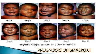 PROGNOSIS OF SMALPOX
 