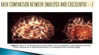 RASH COMPARISON BETWEEN SMALLPOX AND CHICKENPOX :-)
 