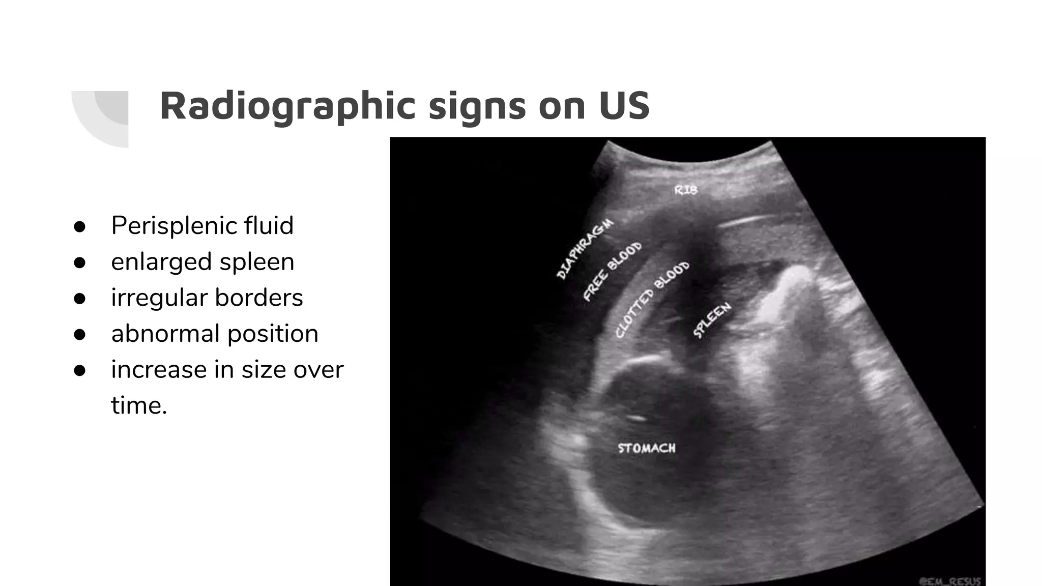 Radiographic signs on US
● Perisplenic fluid
● enlarged spleen
● irregular borders
● abnormal position
● increase in size over
time.
 