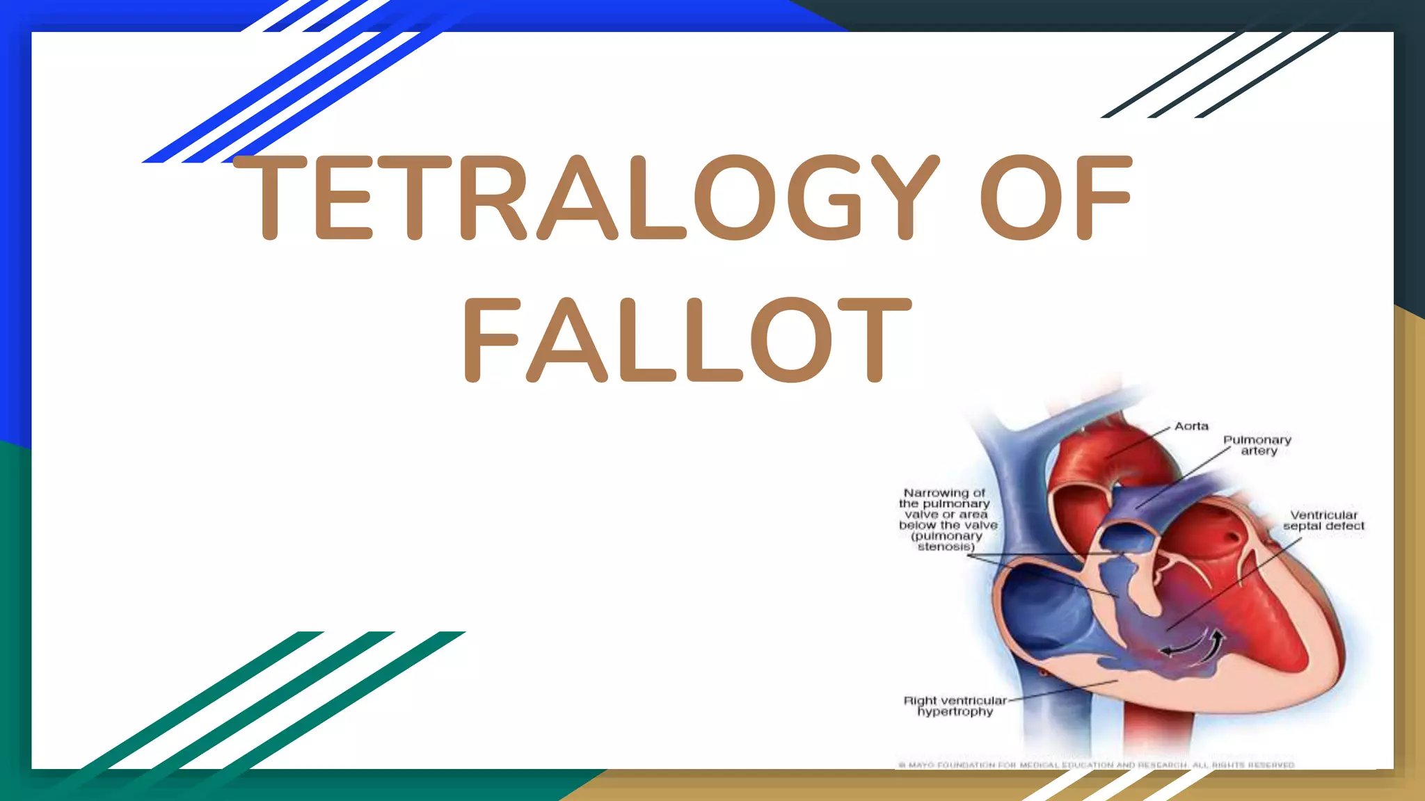 TETRALOGY OF
FALLOT
 