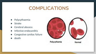 COMPLICATIONS
● Polycythaemia
● Stroke
● Cerebral abscess
● Infective endocarditis
● Congestive cardiac failure
● death
 