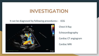 INVESTIGATION
It can be diagnosed by following procedures:- ECG
Chest X-Ray
Echocardiography
Cardiac CT angiogram
Cardiac MRI
 