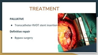 TREATMENT
PALLIATIVE
● Transcatheter RVOT stent insertion
Definitive repair
● Bypass surgery
 