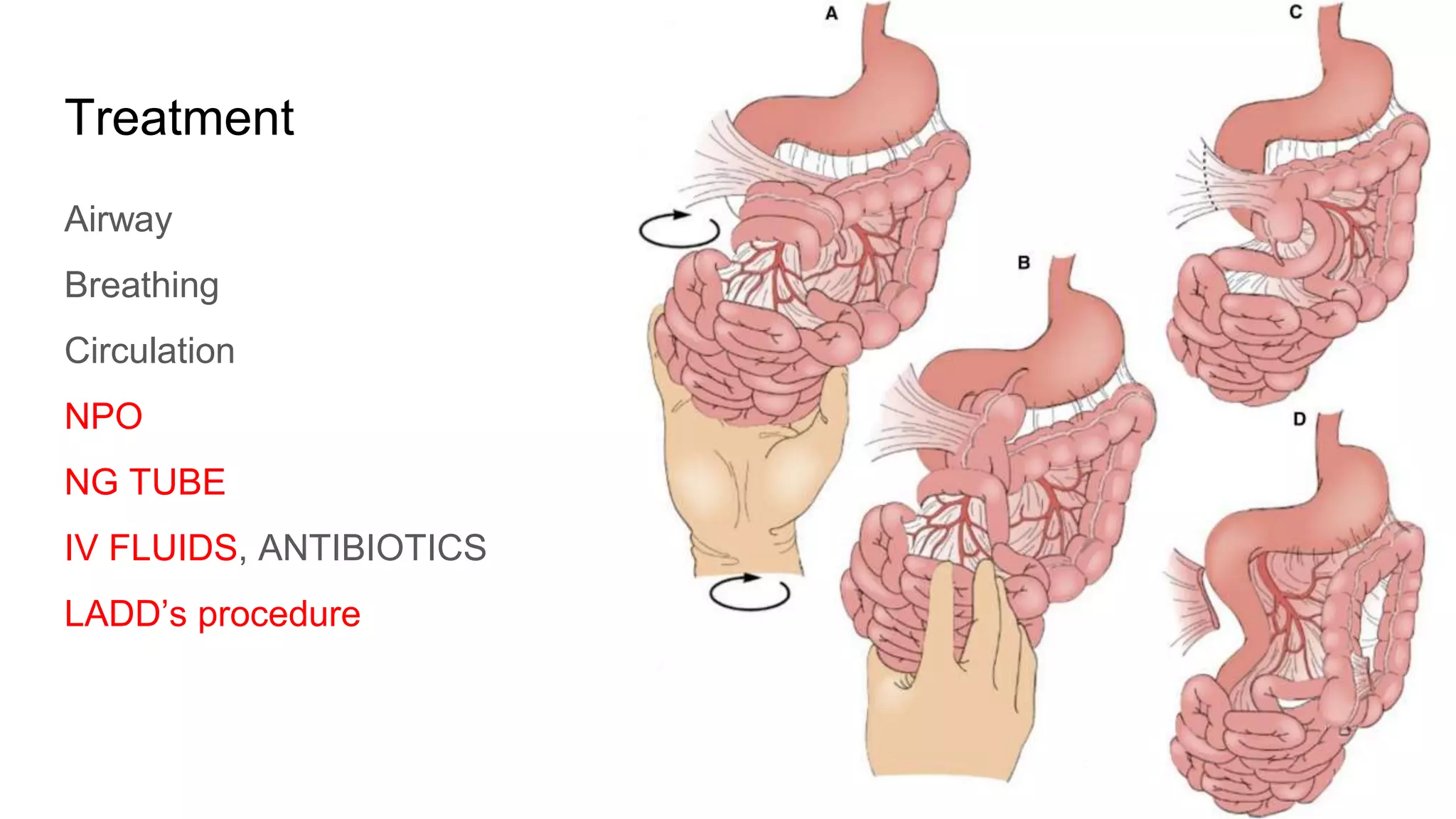 Treatment
Airway
Breathing
Circulation
NPO
NG TUBE
IV FLUIDS, ANTIBIOTICS
LADD’s procedure
 