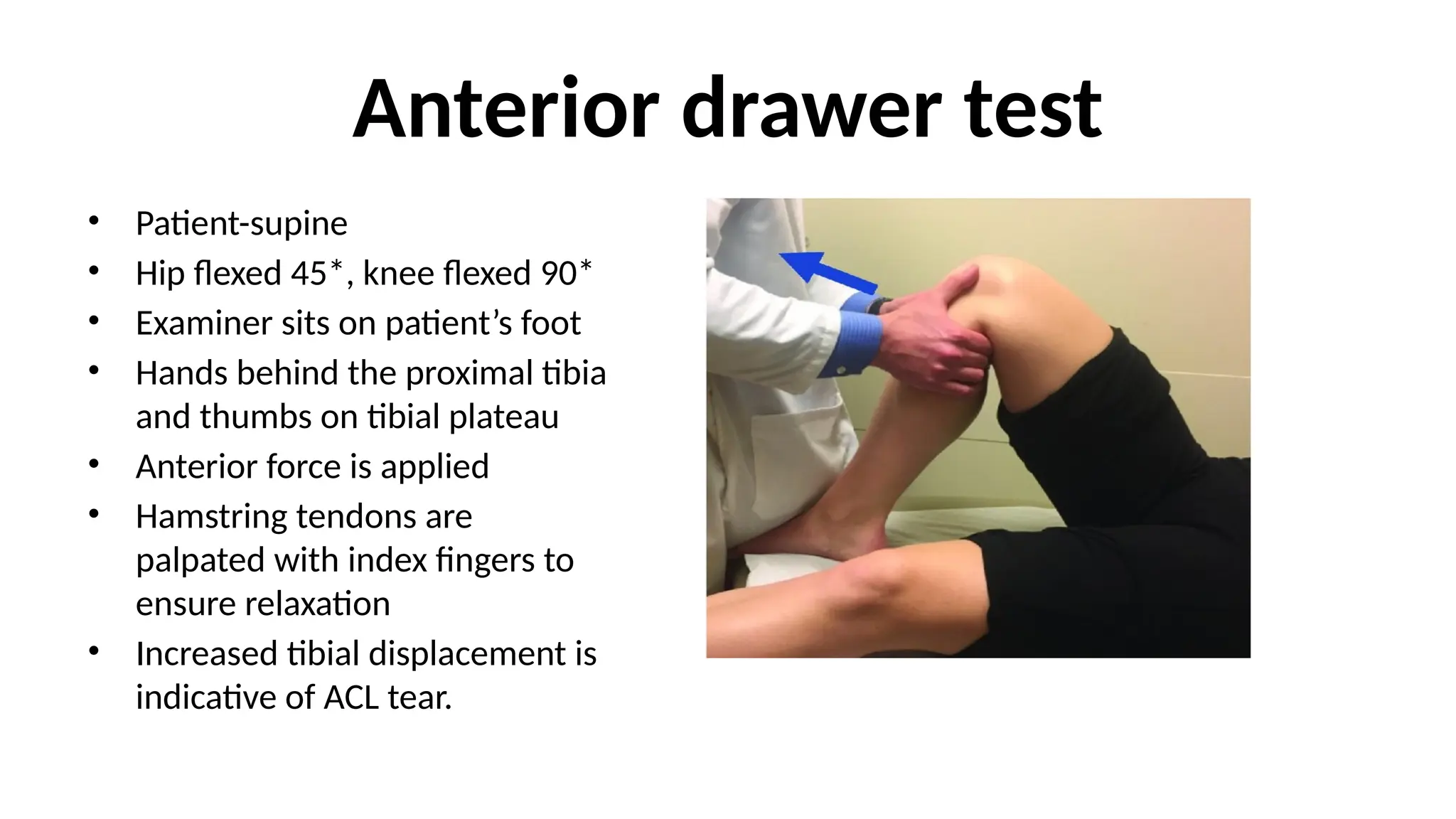 Anterior drawer test
• Patient-supine
• Hip flexed 45*, knee flexed 90*
• Examiner sits on patient’s foot
• Hands behind the proximal tibia
and thumbs on tibial plateau
• Anterior force is applied
• Hamstring tendons are
palpated with index fingers to
ensure relaxation
• Increased tibial displacement is
indicative of ACL tear.
 