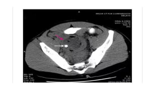 Comprehensive Overview of Intra-Abdominal Abscesses: Diagnosis ...