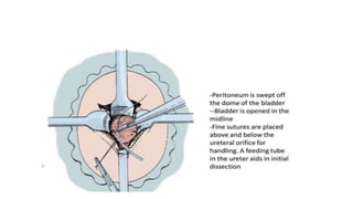 Comprehensive Management of Vesicoureteral Reflux (VUR) in Children and ...