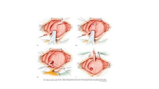 Comprehensive Management of Vesicoureteral Reflux (VUR) in Children and ...