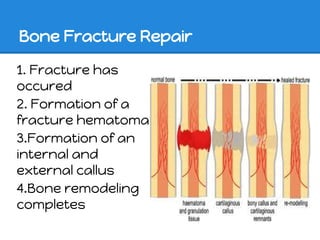 Bone Fracture Repair

1. Fracture has
occured
2. Formation of a
fracture hematoma
3.Formation of an
internal and
external callus
4.Bone remodeling
completes
 