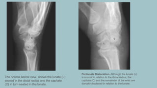 appendicular trauma in radiology. .pptx