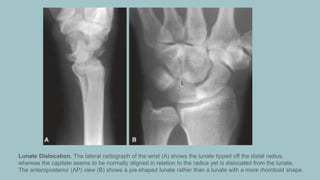 appendicular trauma in radiology. .pptx
