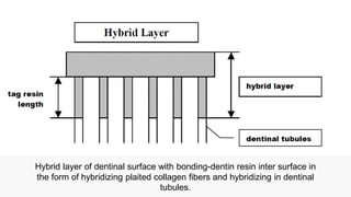 Comprehensive Overview of Dentin Hybrid Layer Formation and ...