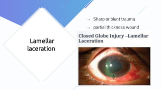 Lamellar
laceration
⇢ Sharp or blunt trauma
⇢ partial thickness wound
 