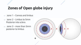 Zones of Open globe injury
⇢ zone 1 - Cornea and limbus
⇢ zone 2 - Limbus to 5mm
Posterior into sclera
⇢ zone 3 - more than 5mm
posterior to limbus
 