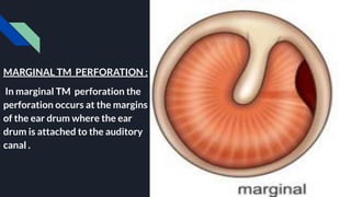 MARGINAL TM PERFORATION :
In marginal TM perforation the
perforation occurs at the margins
of the ear drum where the ear
drum is attached to the auditory
canal .
 