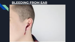 BLEEDING FROM EAR
 